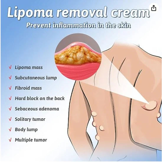 South Moon Lipoma Removal & Body Smoothing Cream - 50g - Herbal Natural Lump & Skin Knot Relief Ointment for Neck & Body